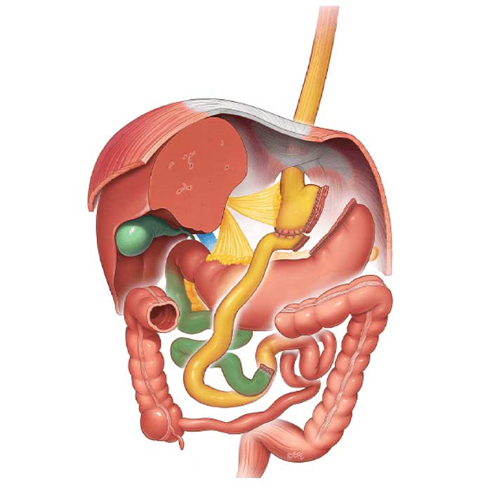 Bypass-Gastrico-en-Y-de-Roux-o-Bypass-Gastrico-tradicional-
